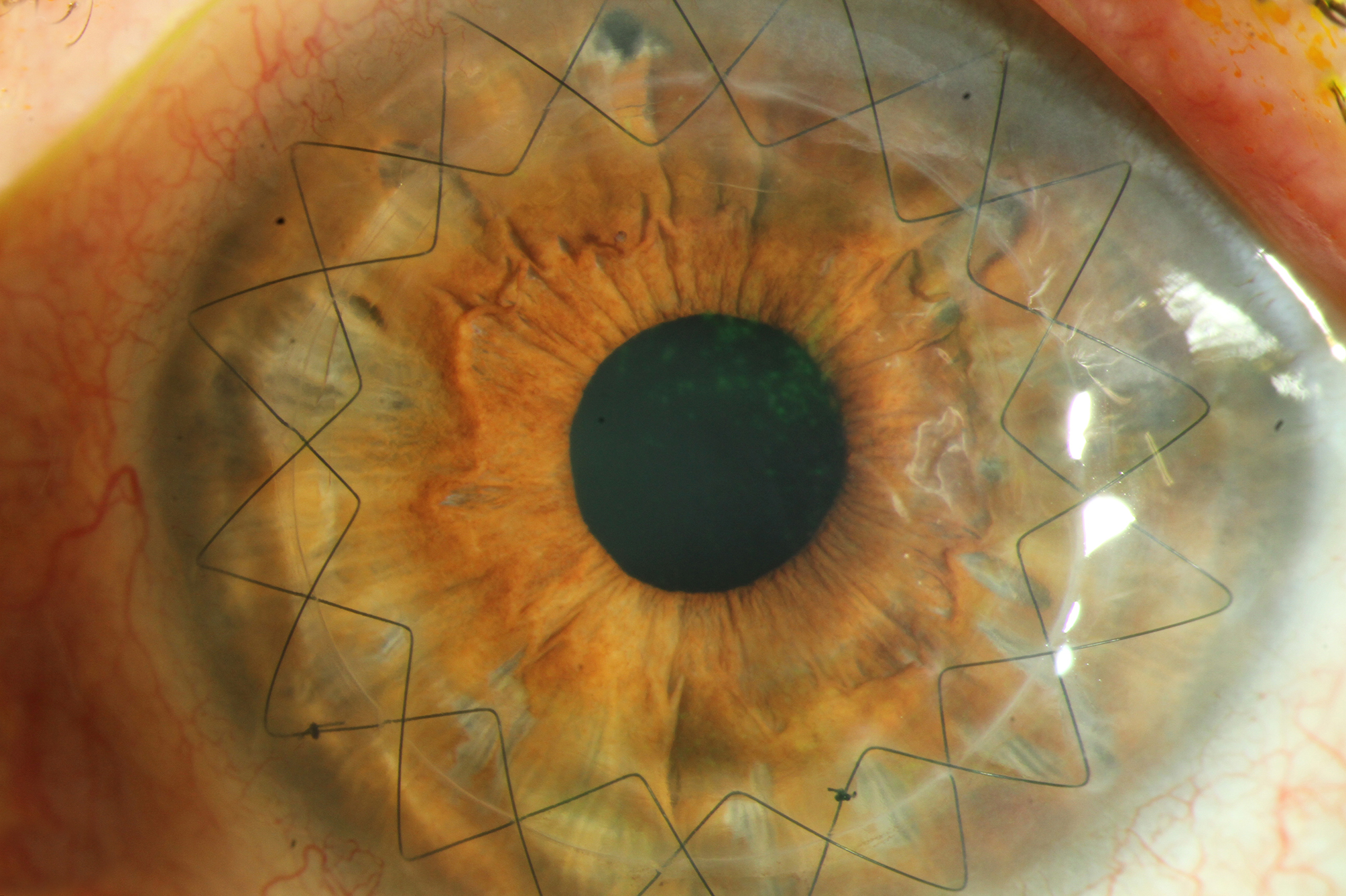 Akanthamöbenkeratitis