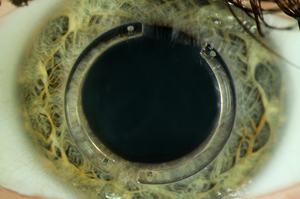 Auge mit zwei implantierten intracornealen Ringsegmenten (ICRS)