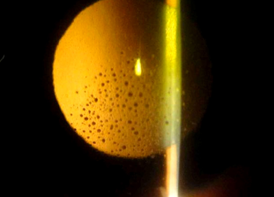 spaltlampenfoto eines Auges mit akuter Regenbogenhautentzün­dung