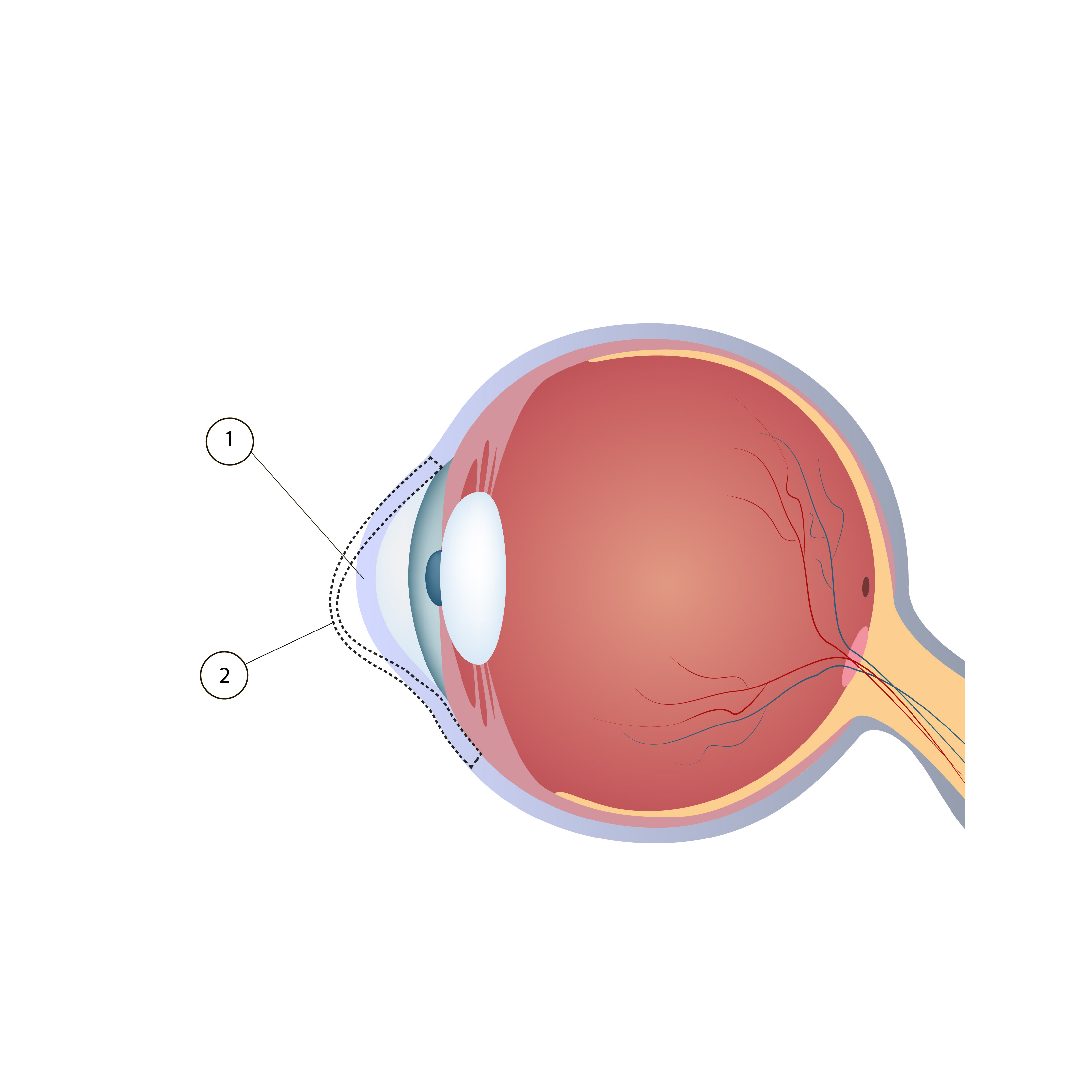 1. schematic shape of the keratoconus cornea 2. schematic shape of the 