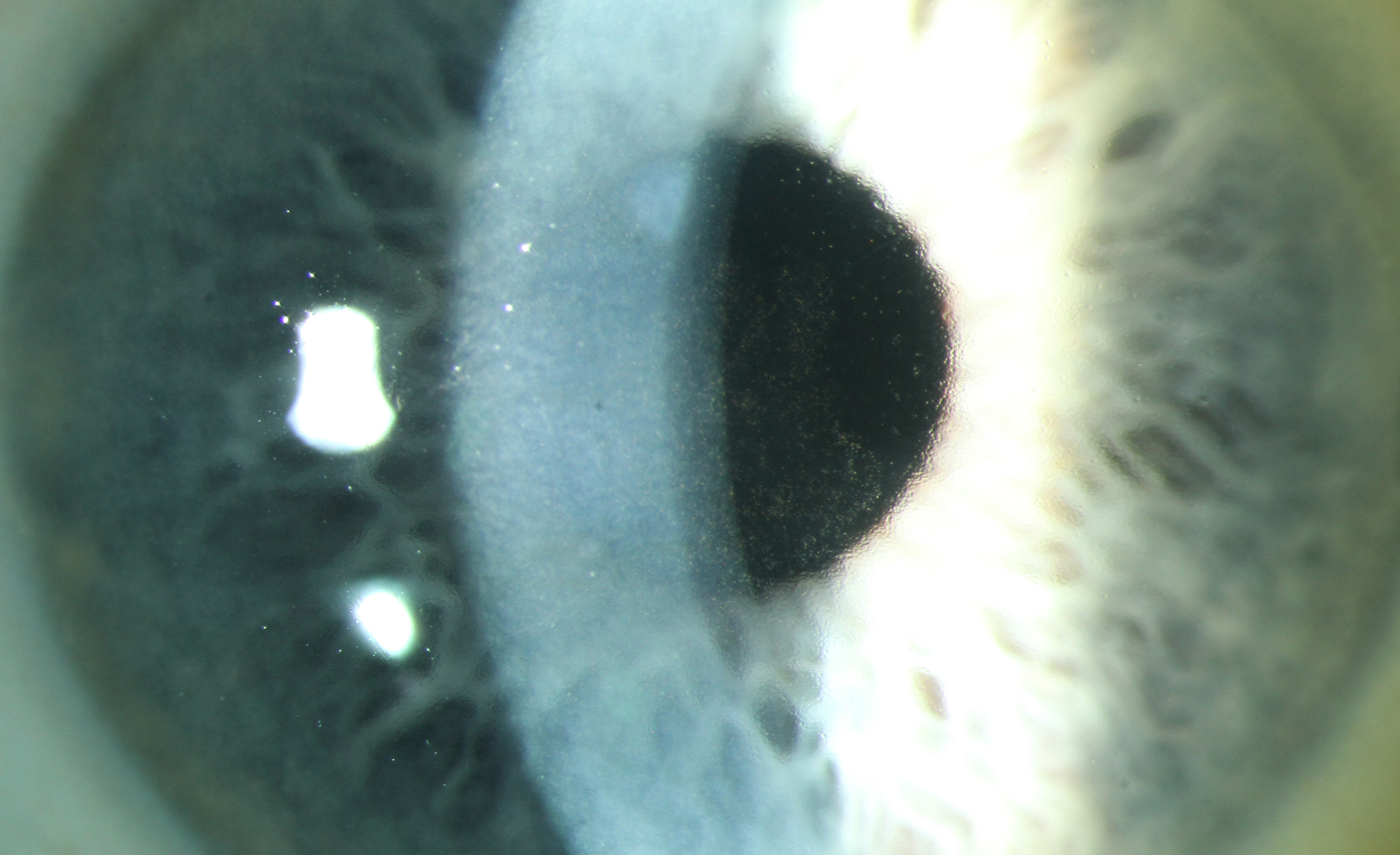 Fuchs corneal endothelial dystrophy