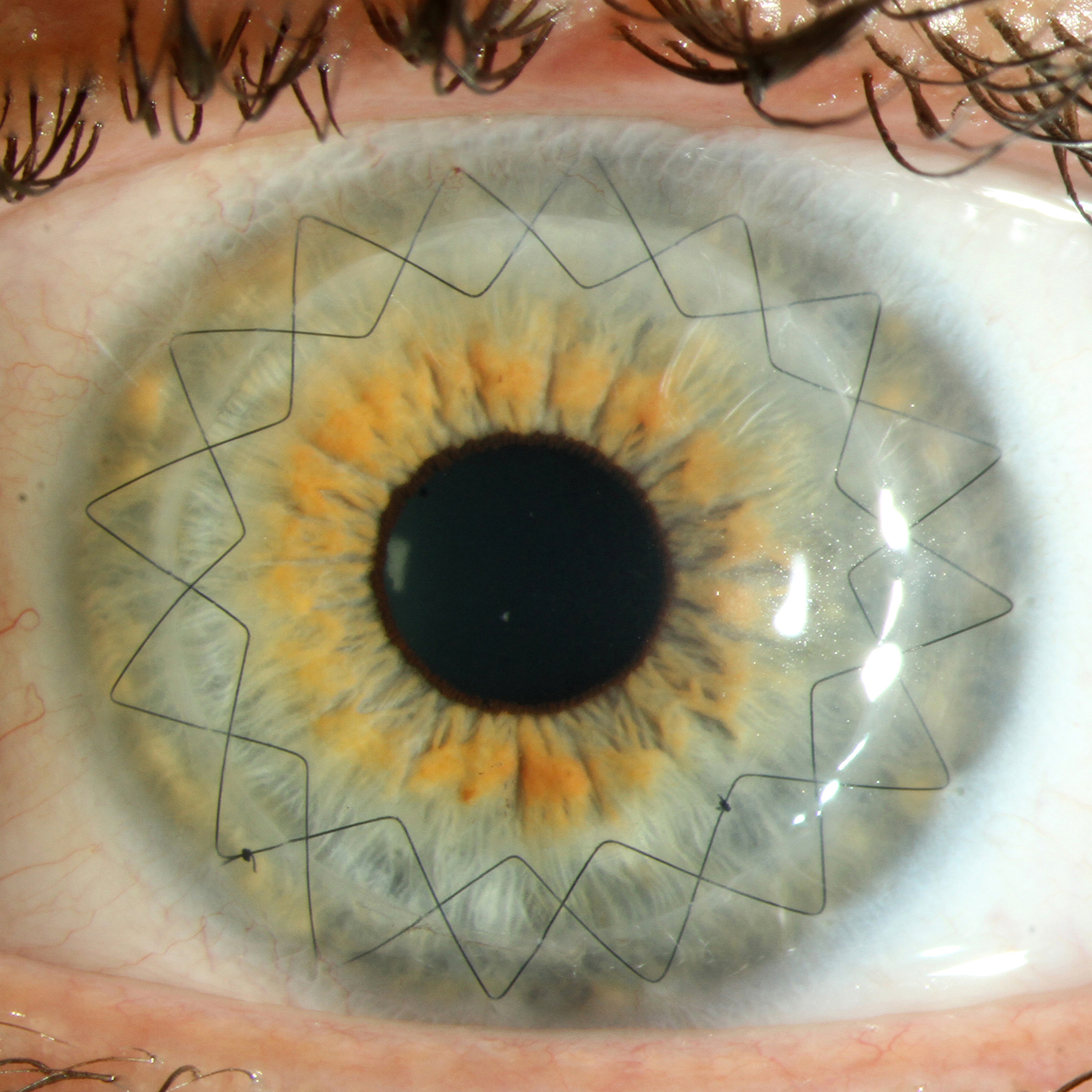 Eye after corneal transplantation with double continuous cross stitch suture